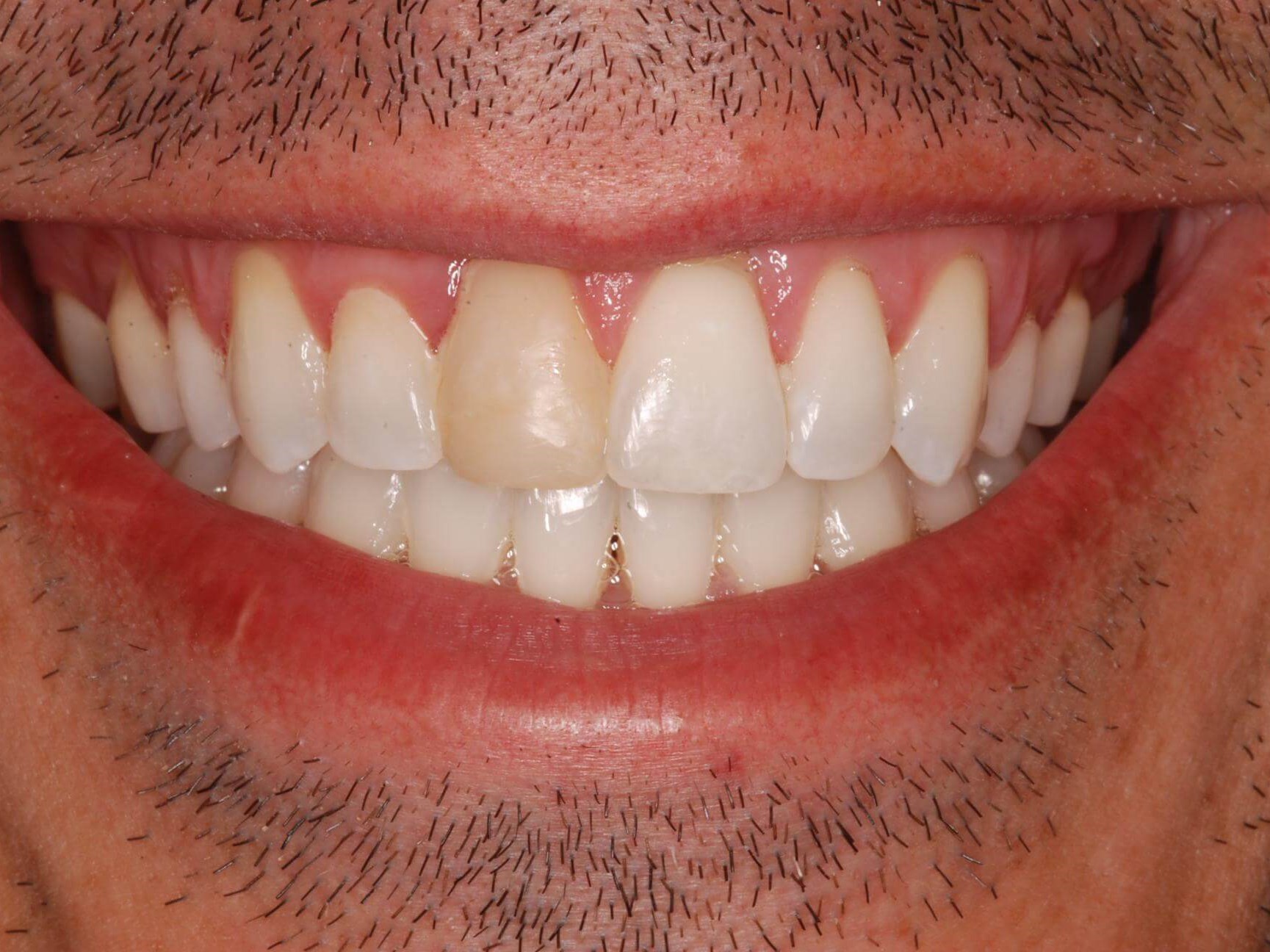 Porcelain Veneers Before