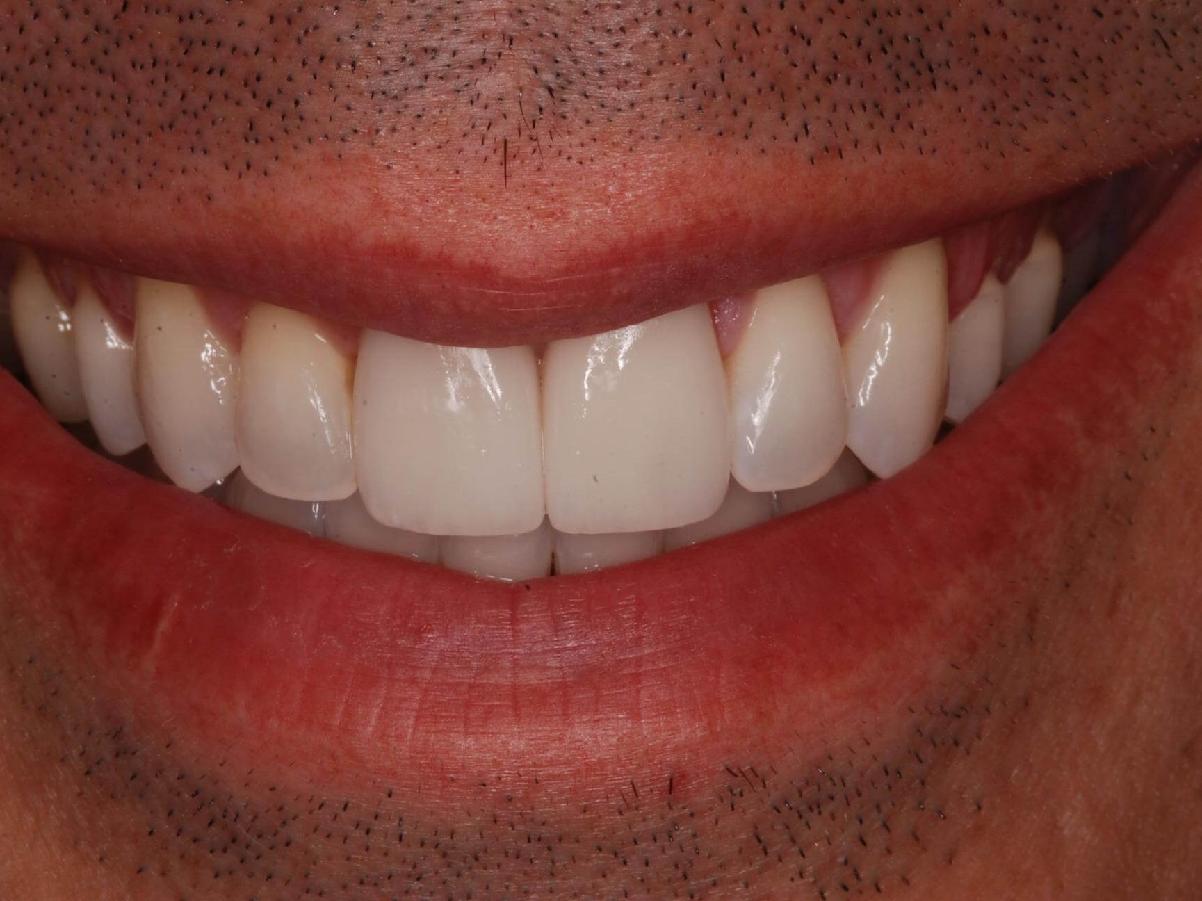 Porcelain Veneers After