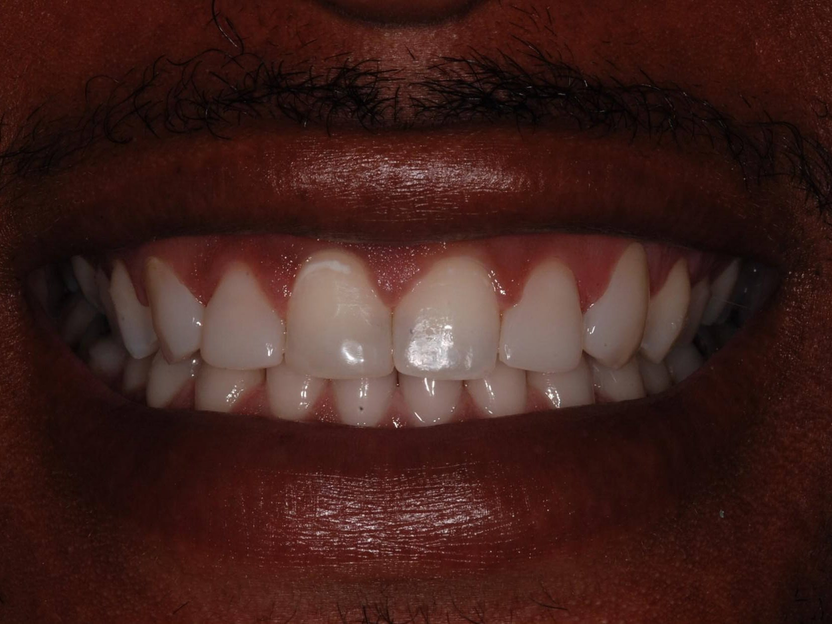 Invisalign® After
