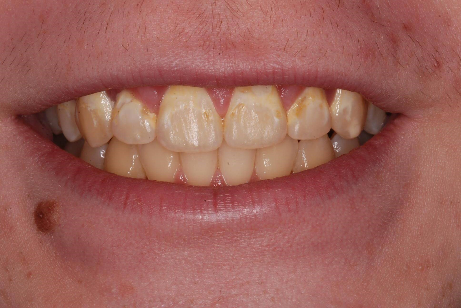 Dental Bonding Before