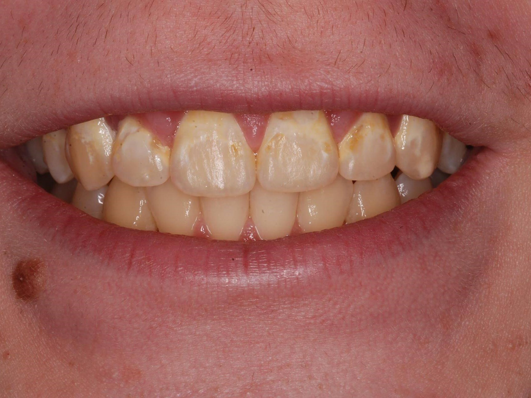 Dental Bonding Before