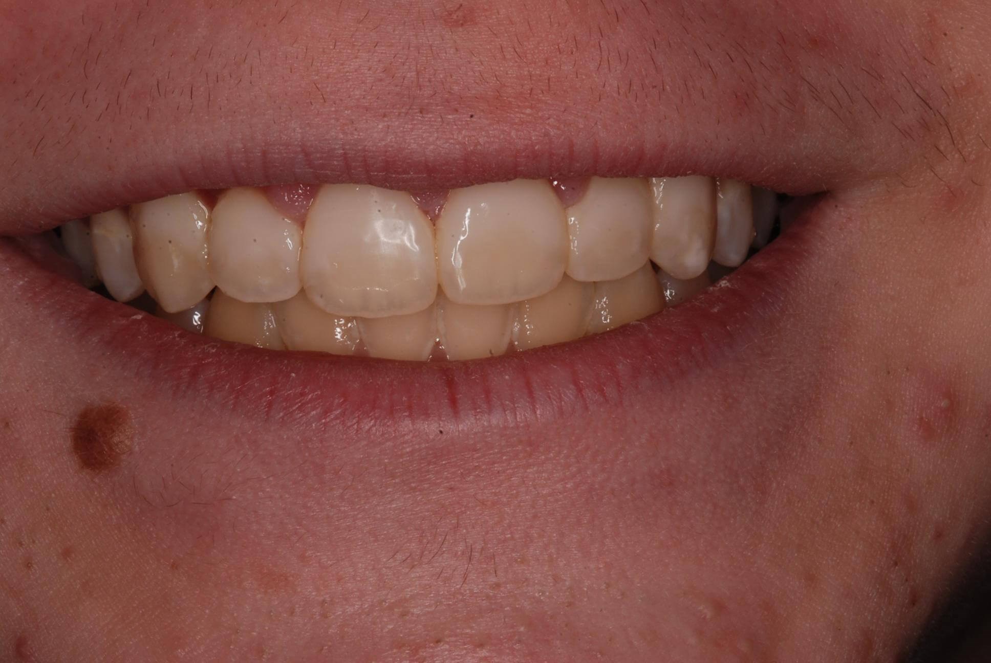 Dental Bonding After