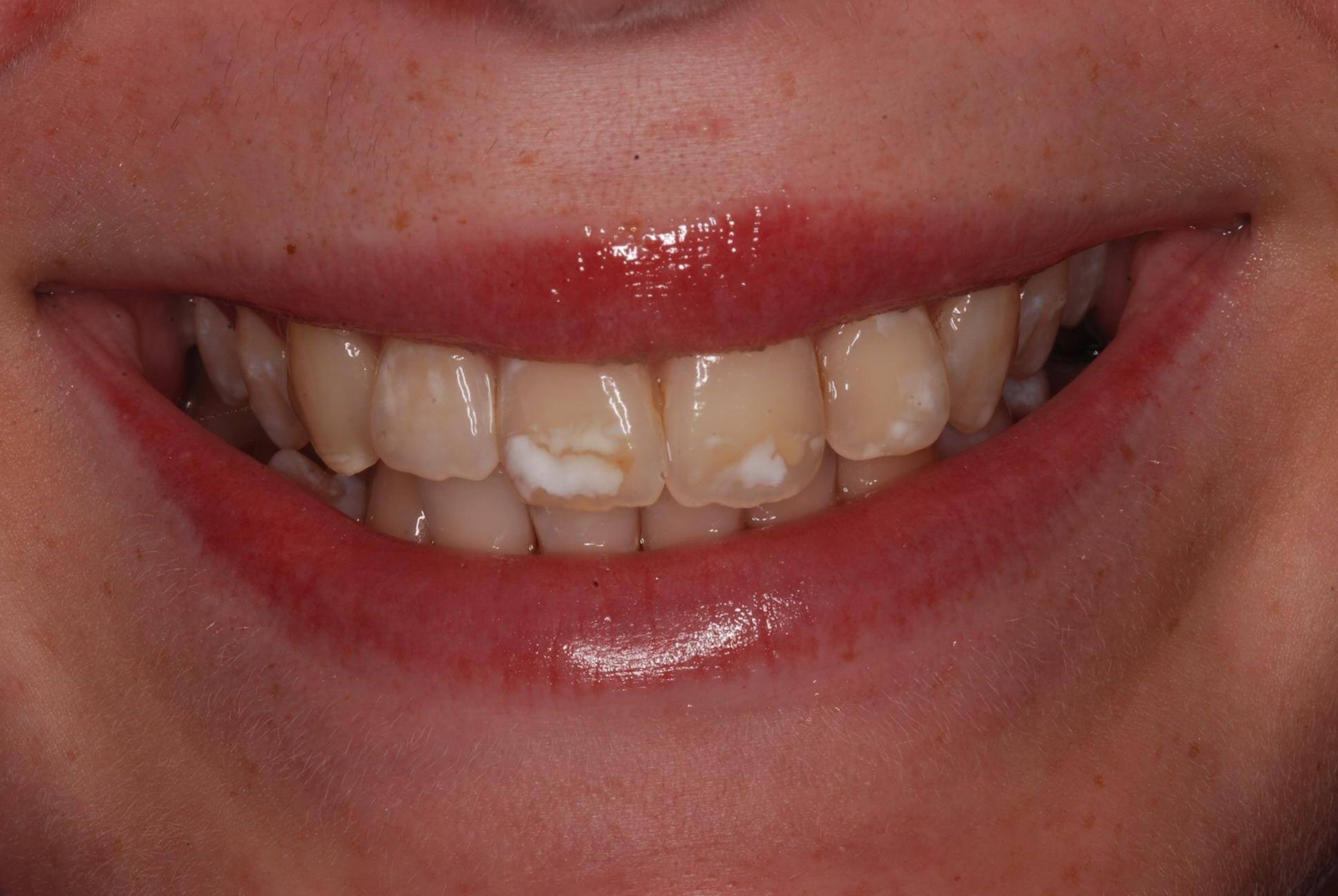 Dental Bonding Before
