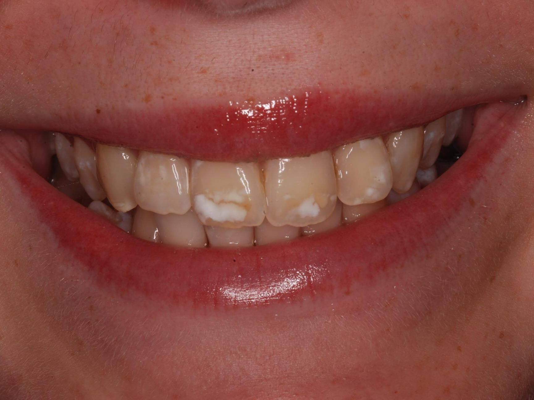 Dental Bonding Before