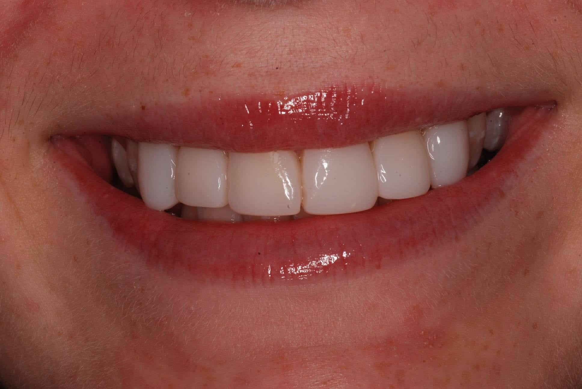 Dental Bonding After
