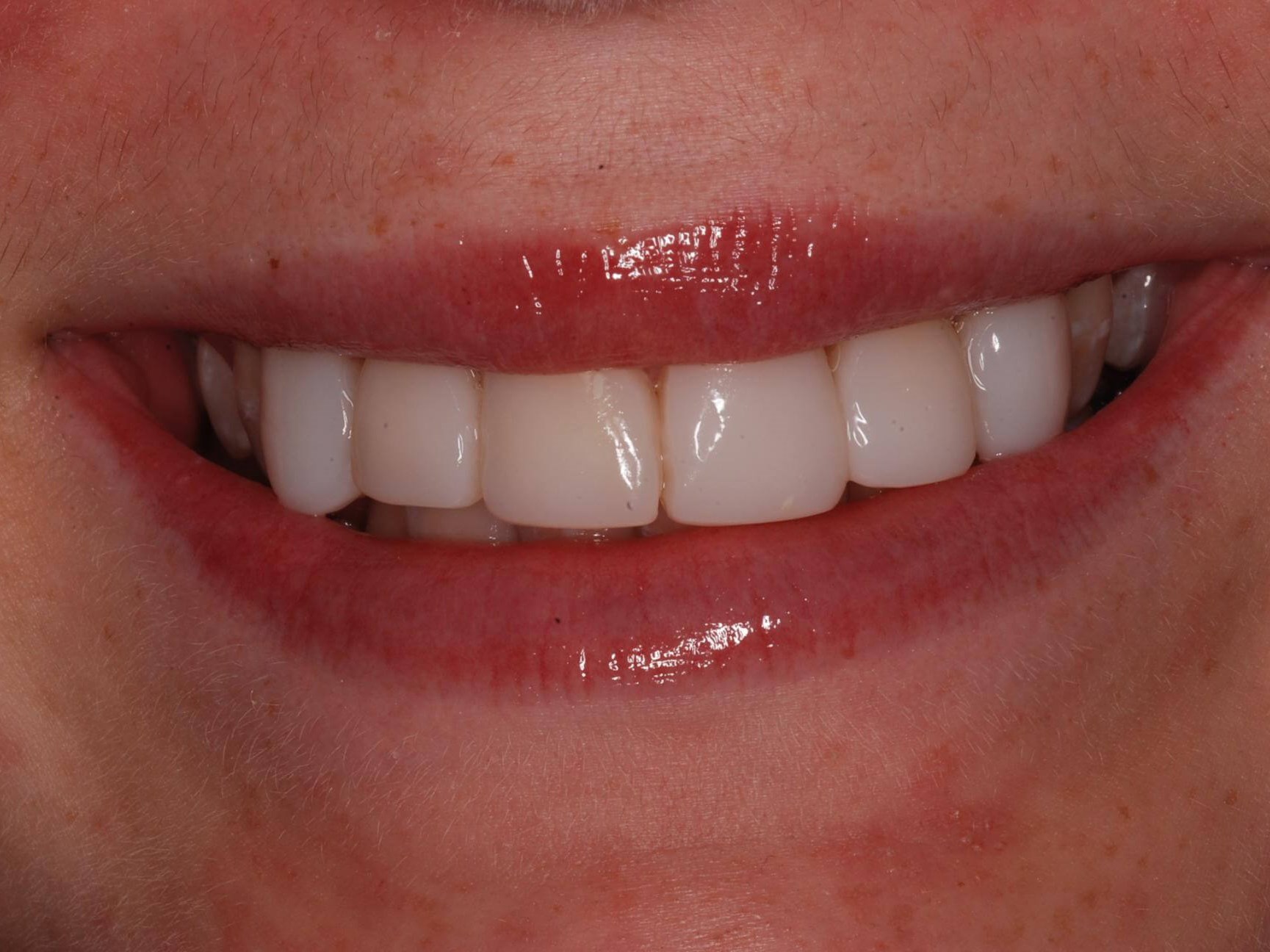 Dental Bonding After