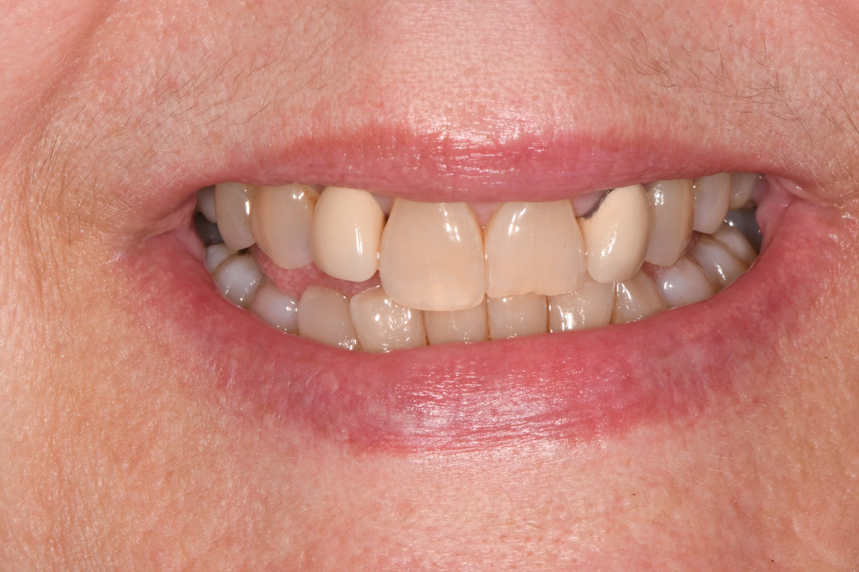 Dental Crowns Before
