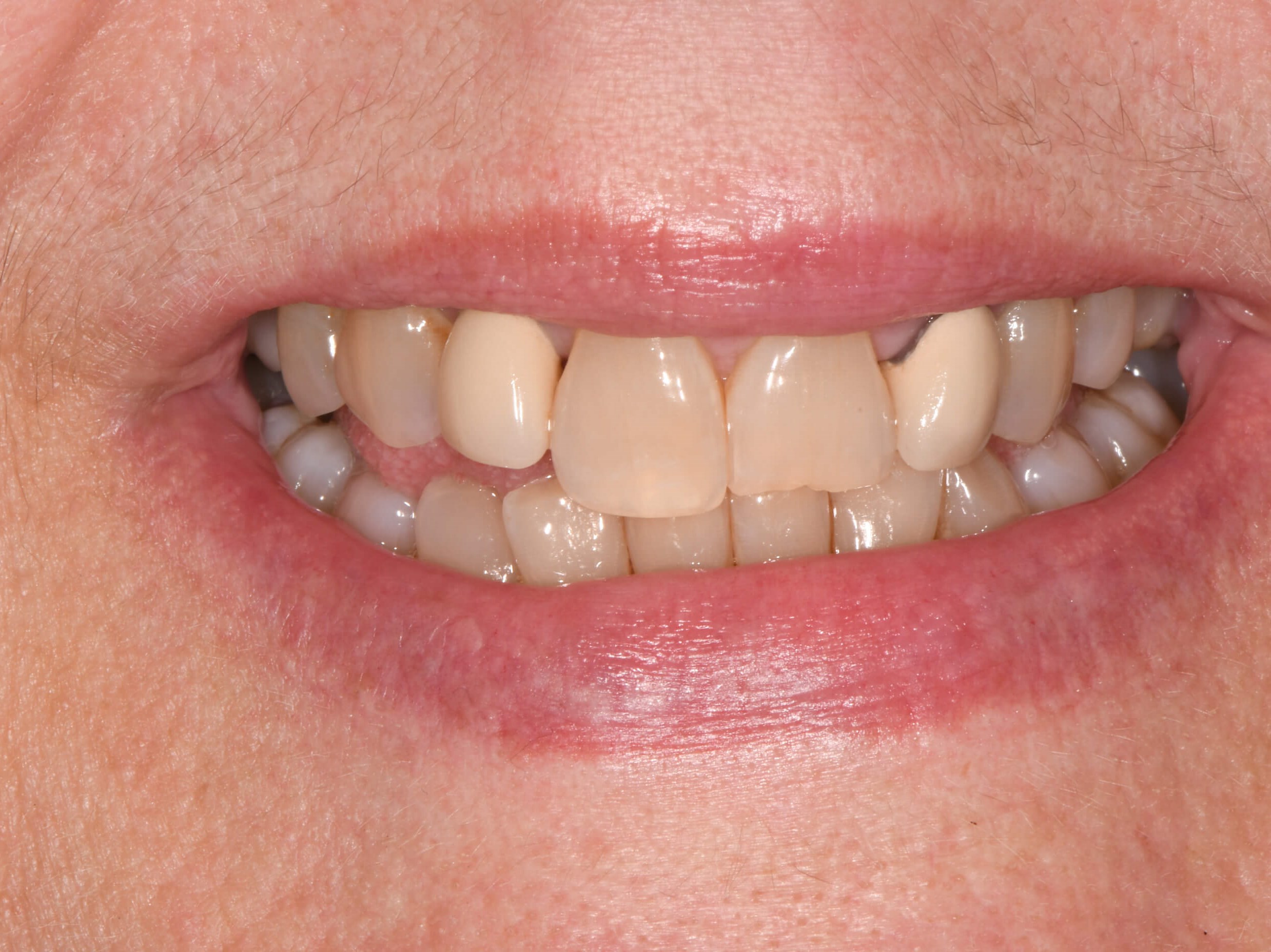 Dental Crowns Before