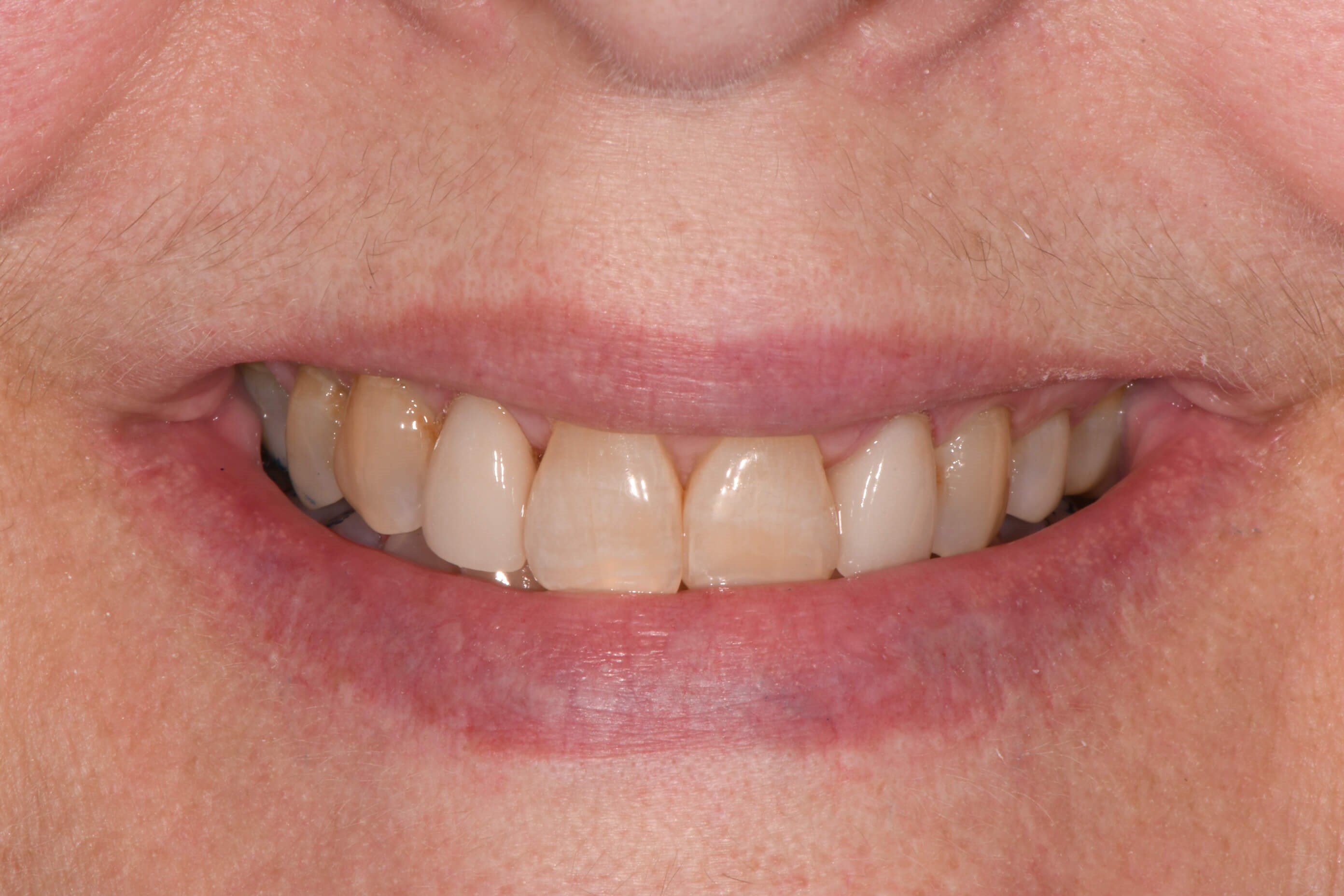 Dental Crowns After