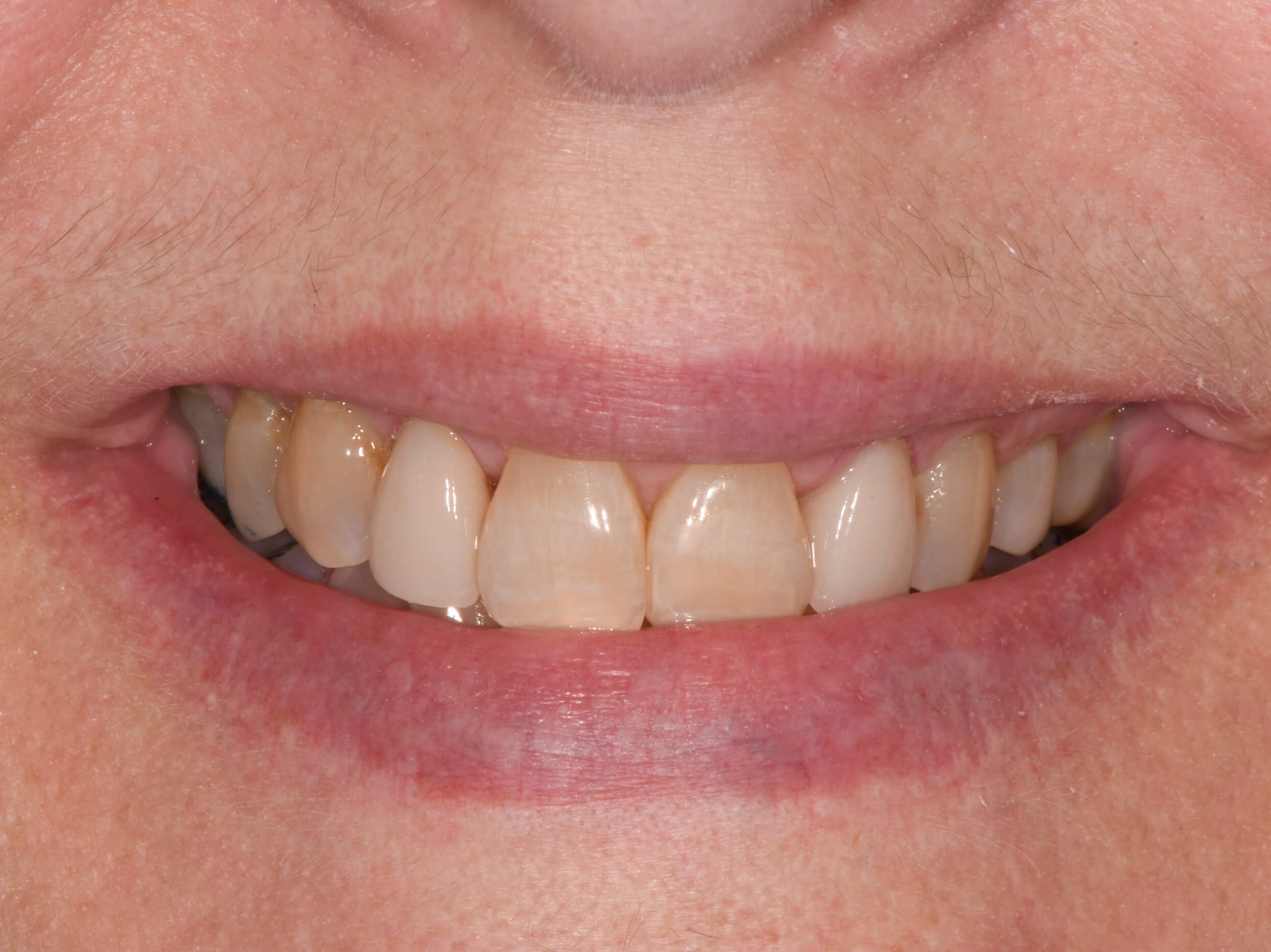 Dental Crowns After