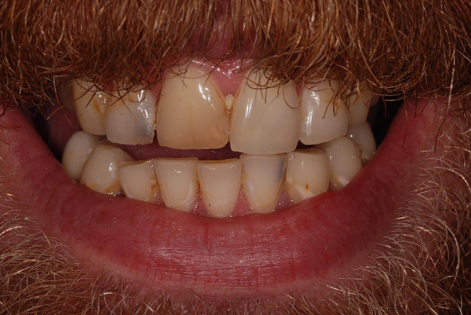 Dental Crowns Before