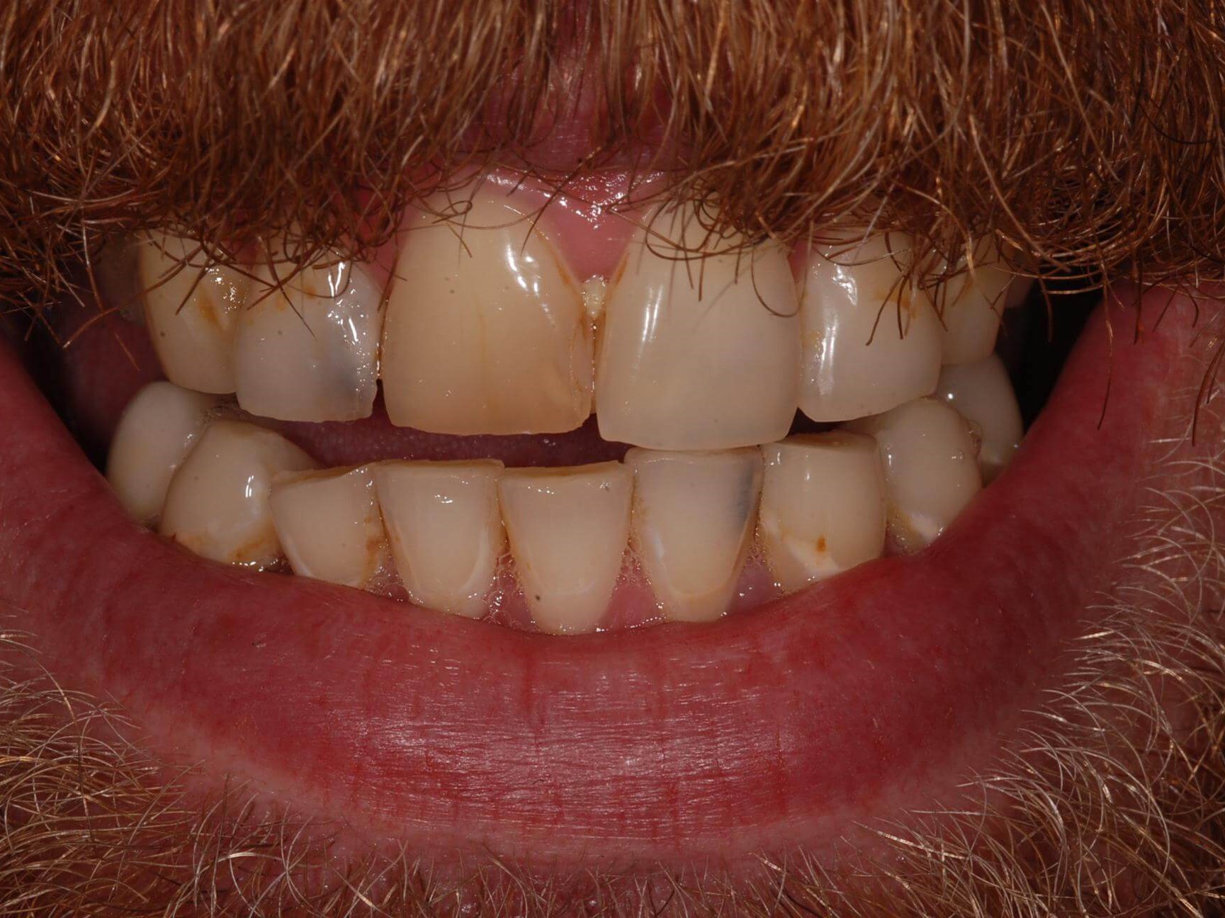 Dental Crowns Before