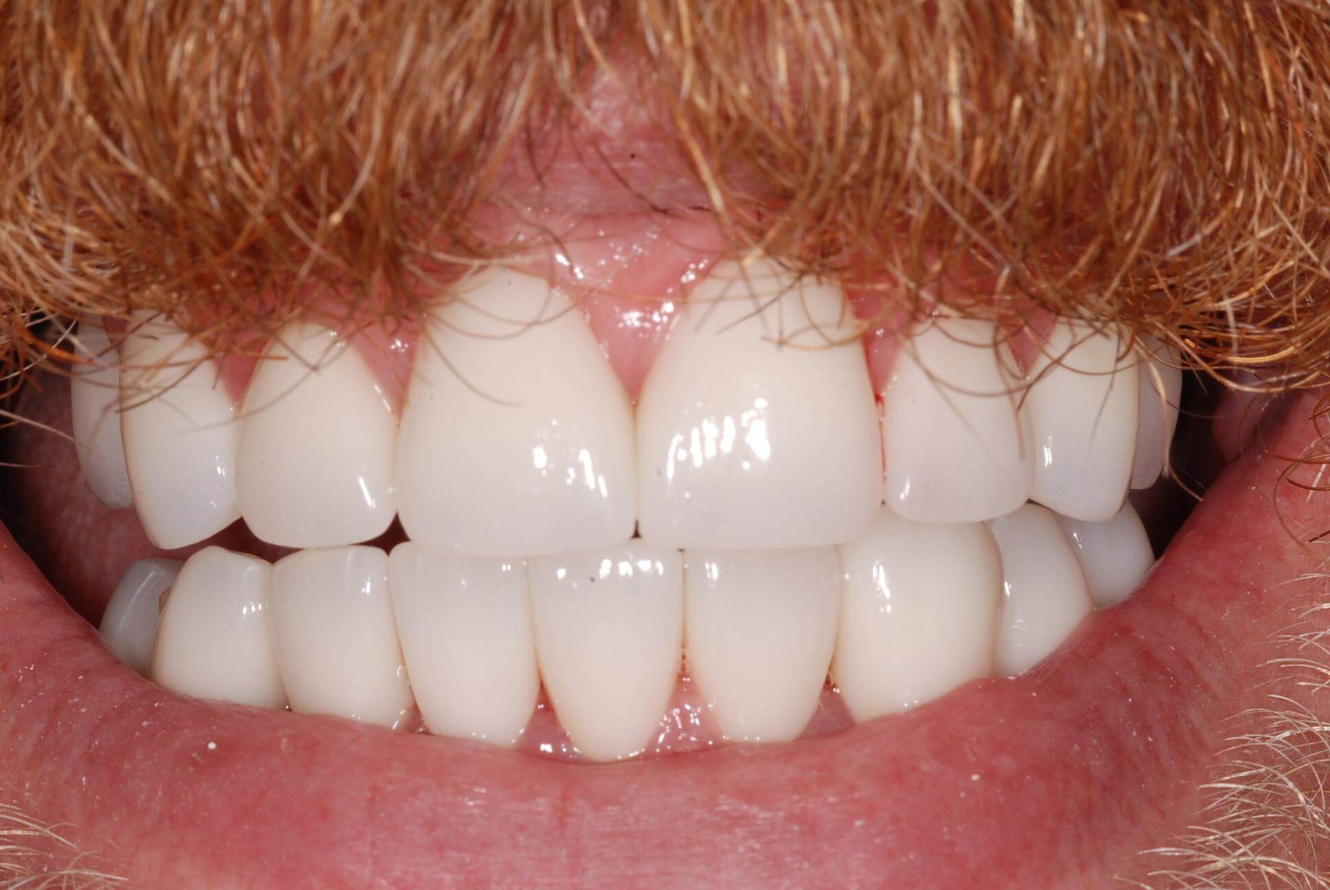 Dental Crowns After