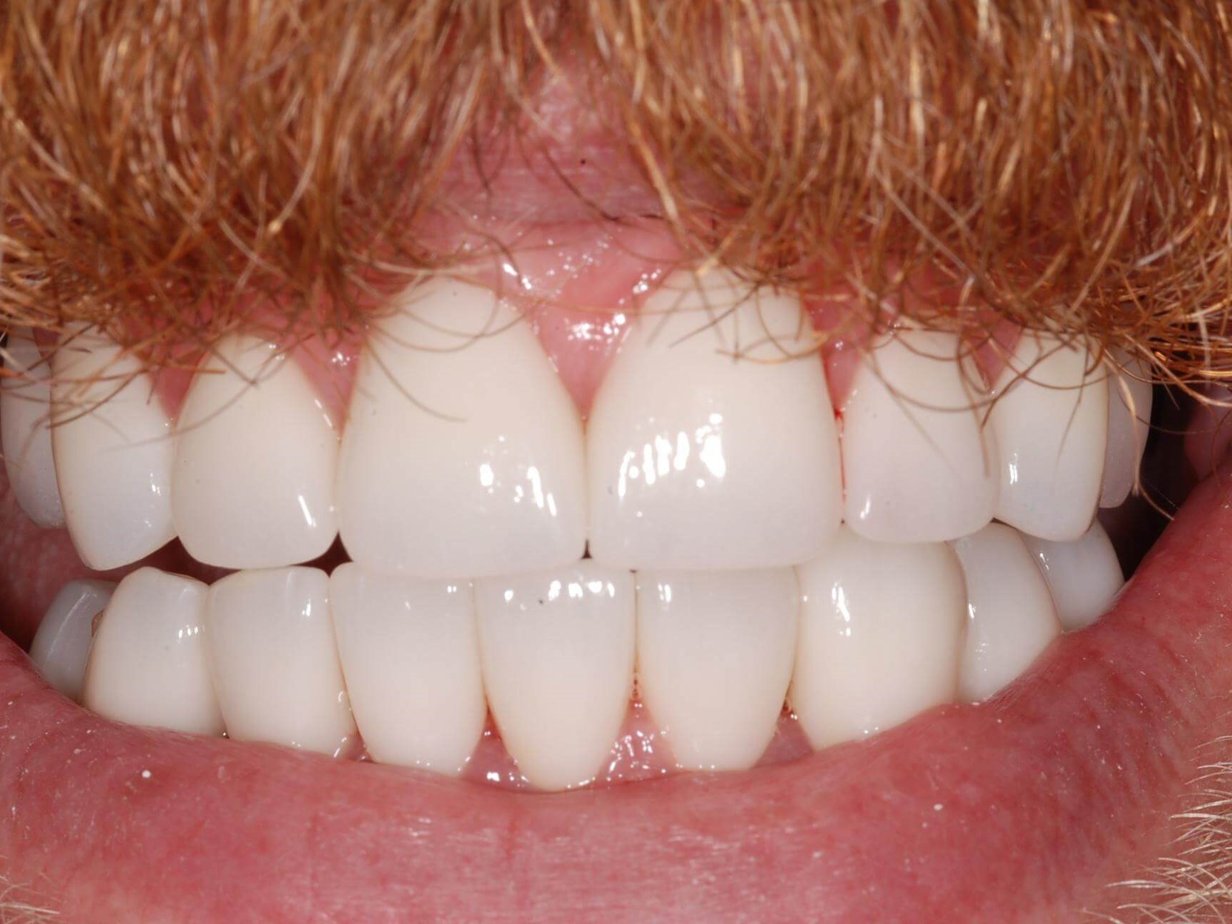 Dental Crowns After