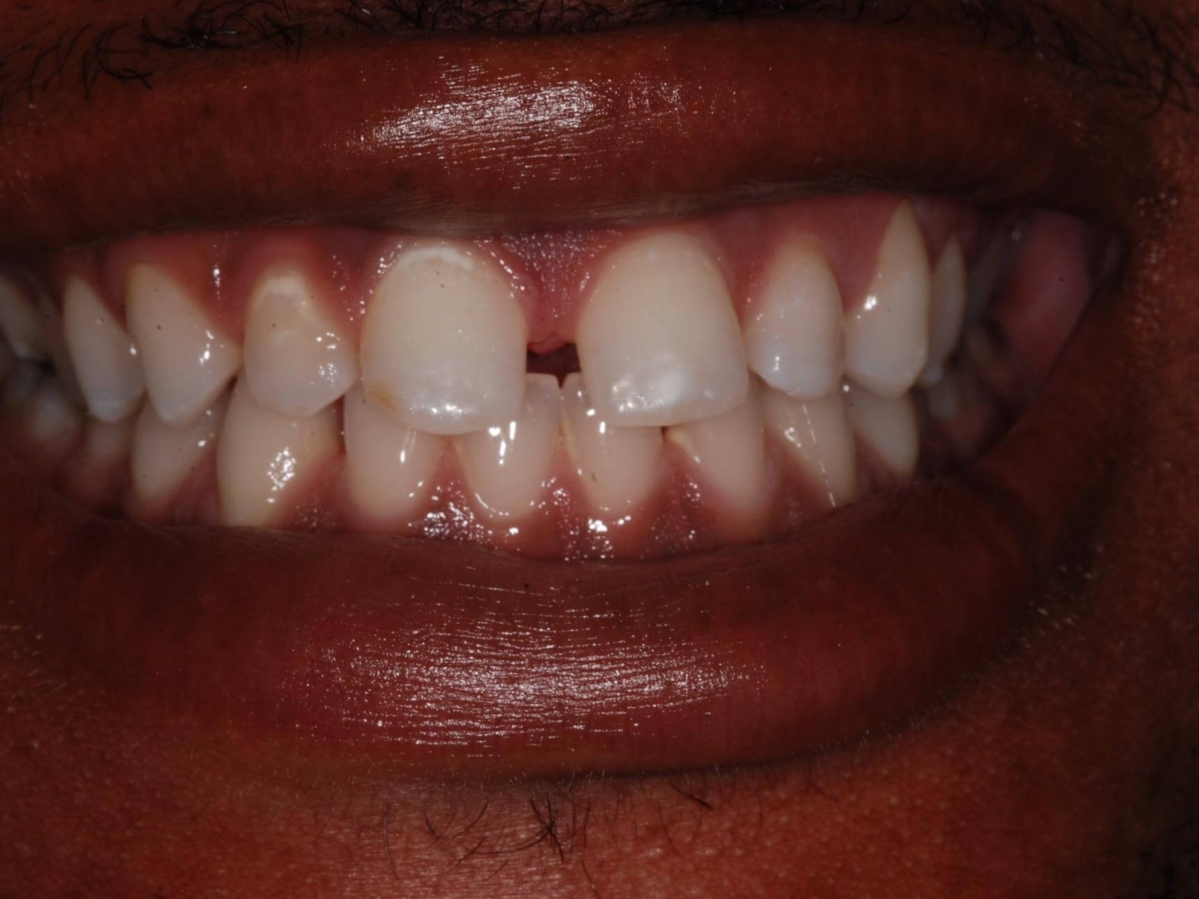 Invisalign® Before