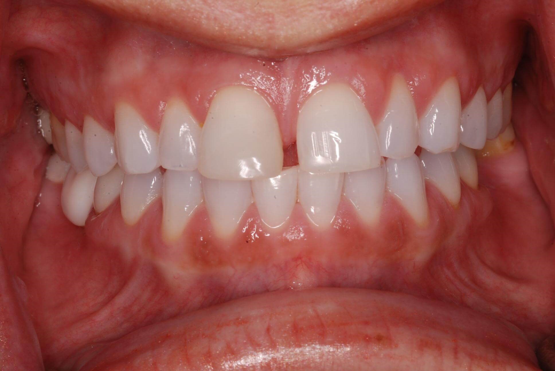 Dental Crowns Before