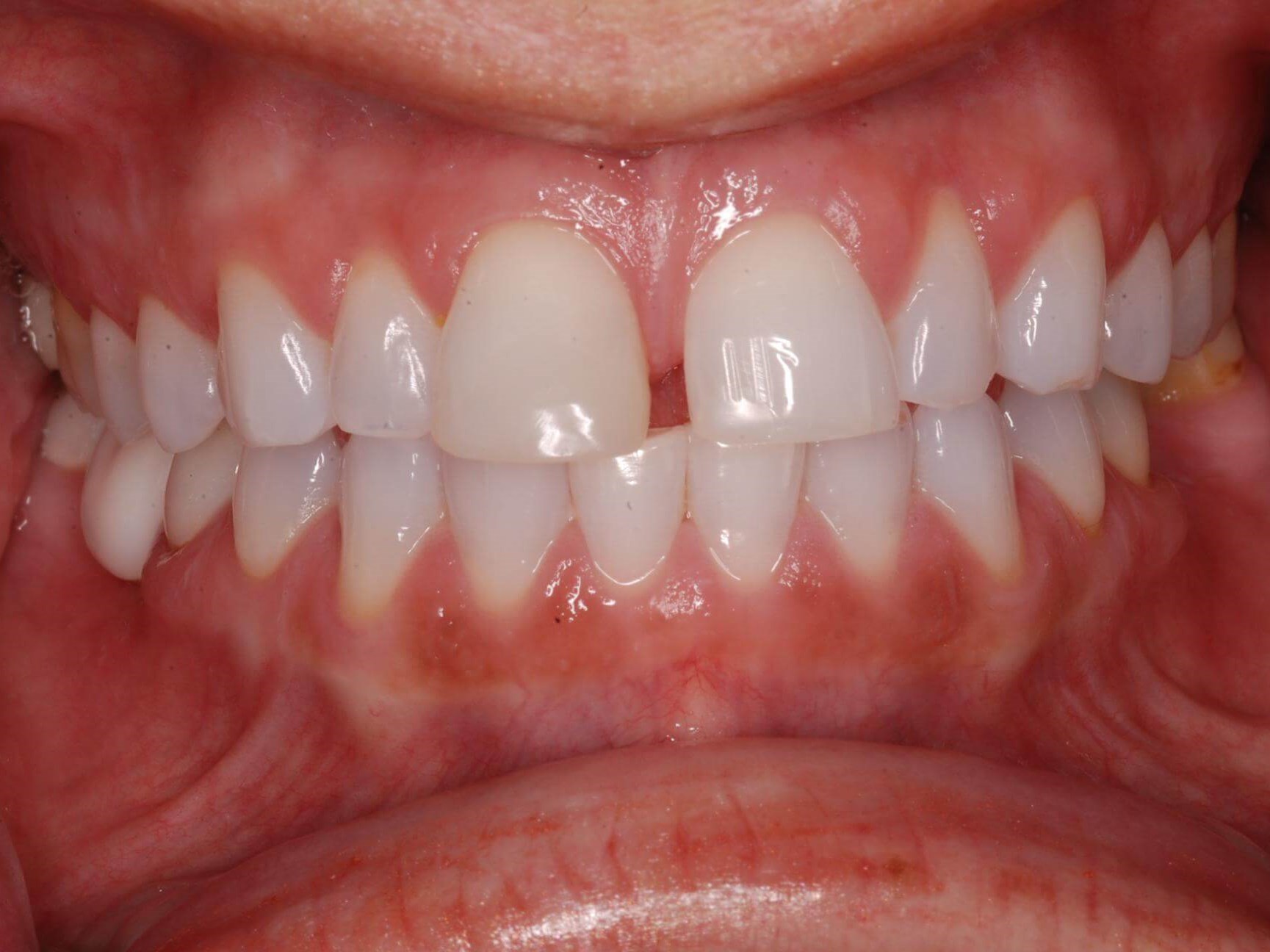 Dental Crowns Before
