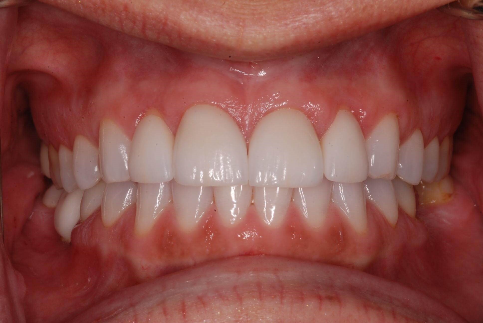 Dental Crowns After