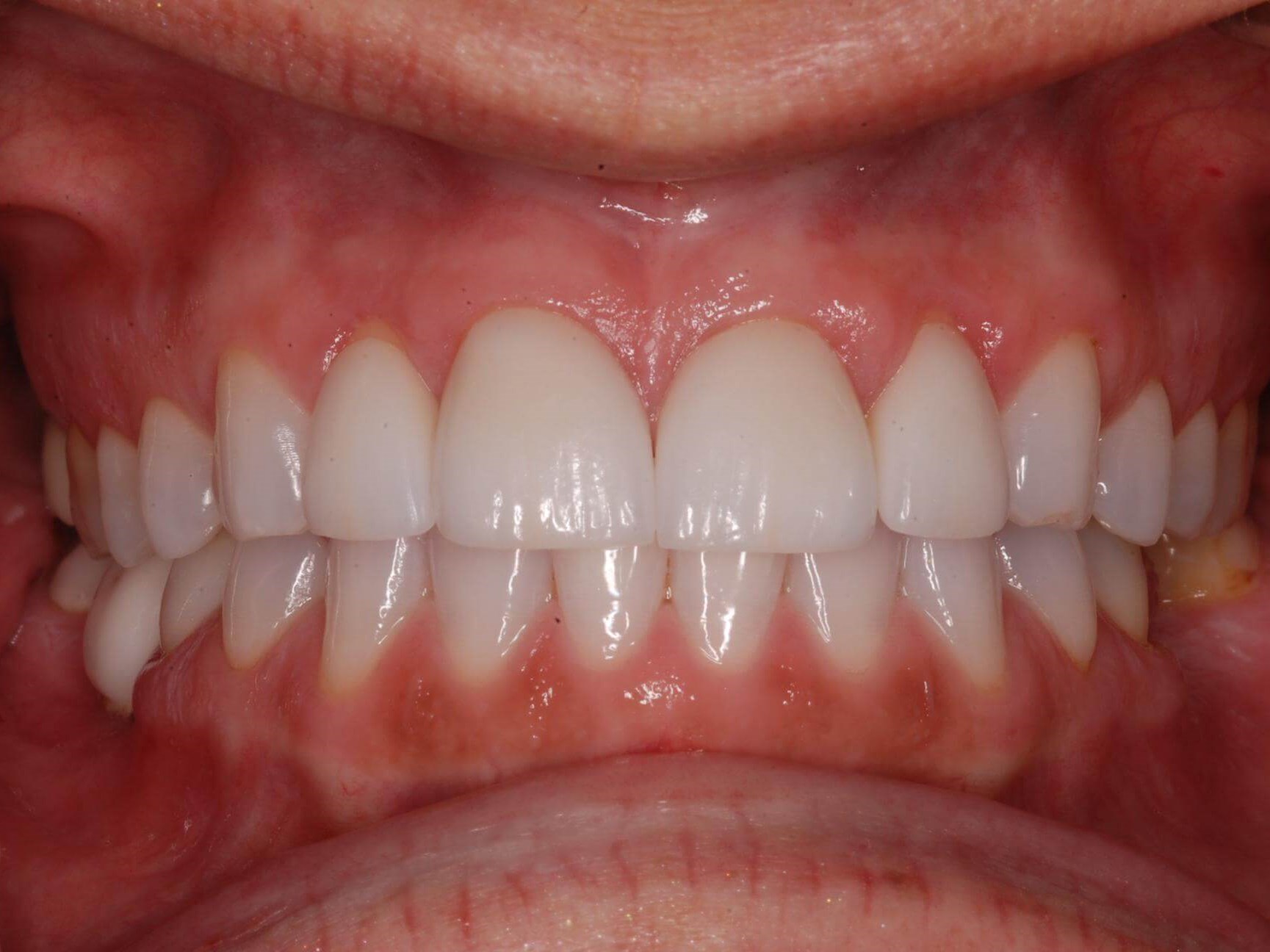 Dental Crowns After