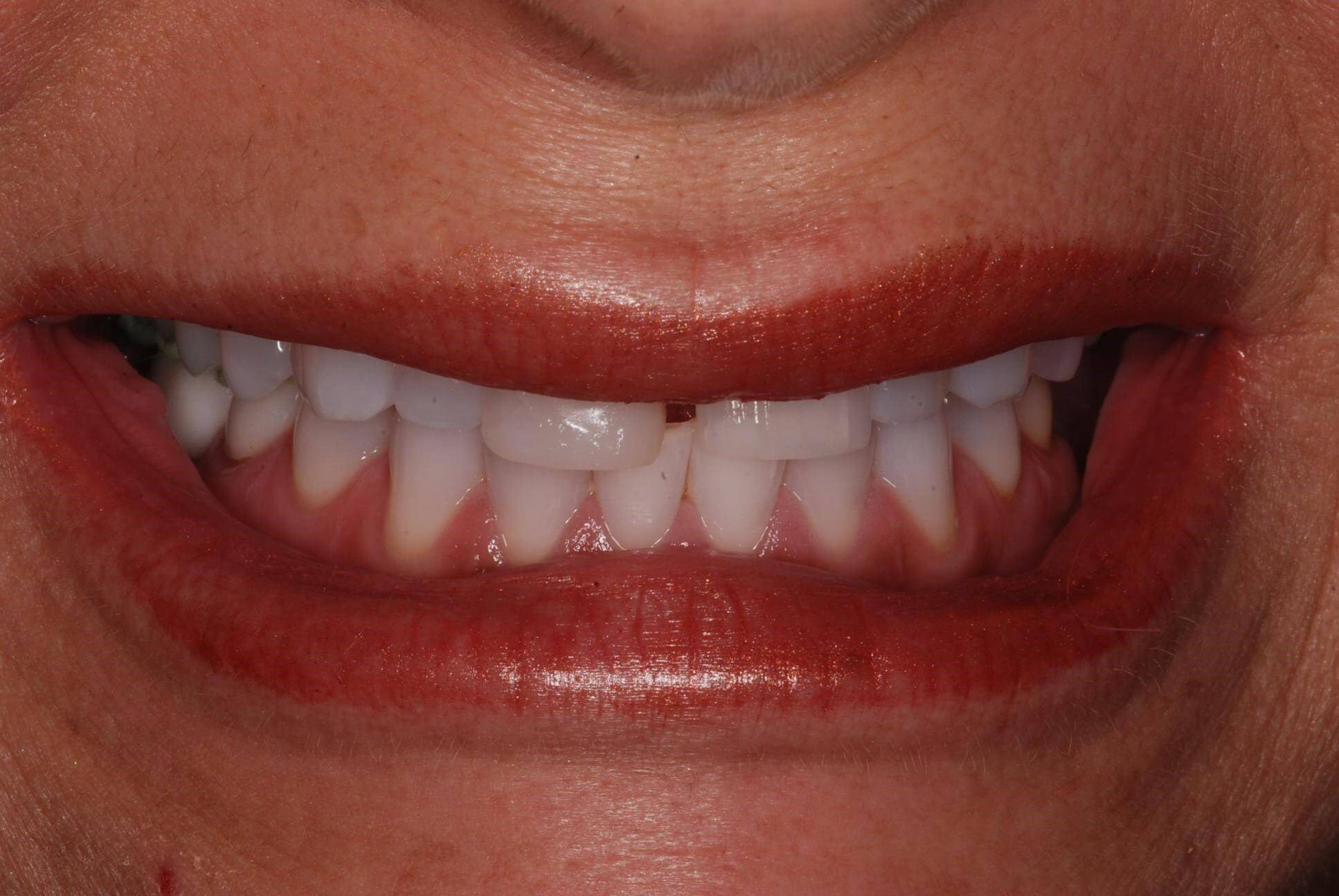 Dental Crowns Before