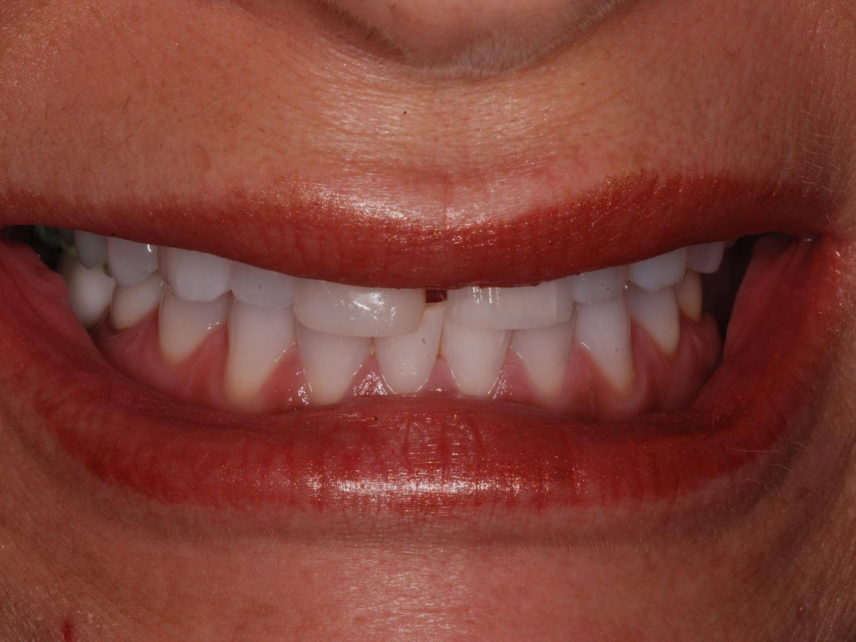Dental Crowns Before