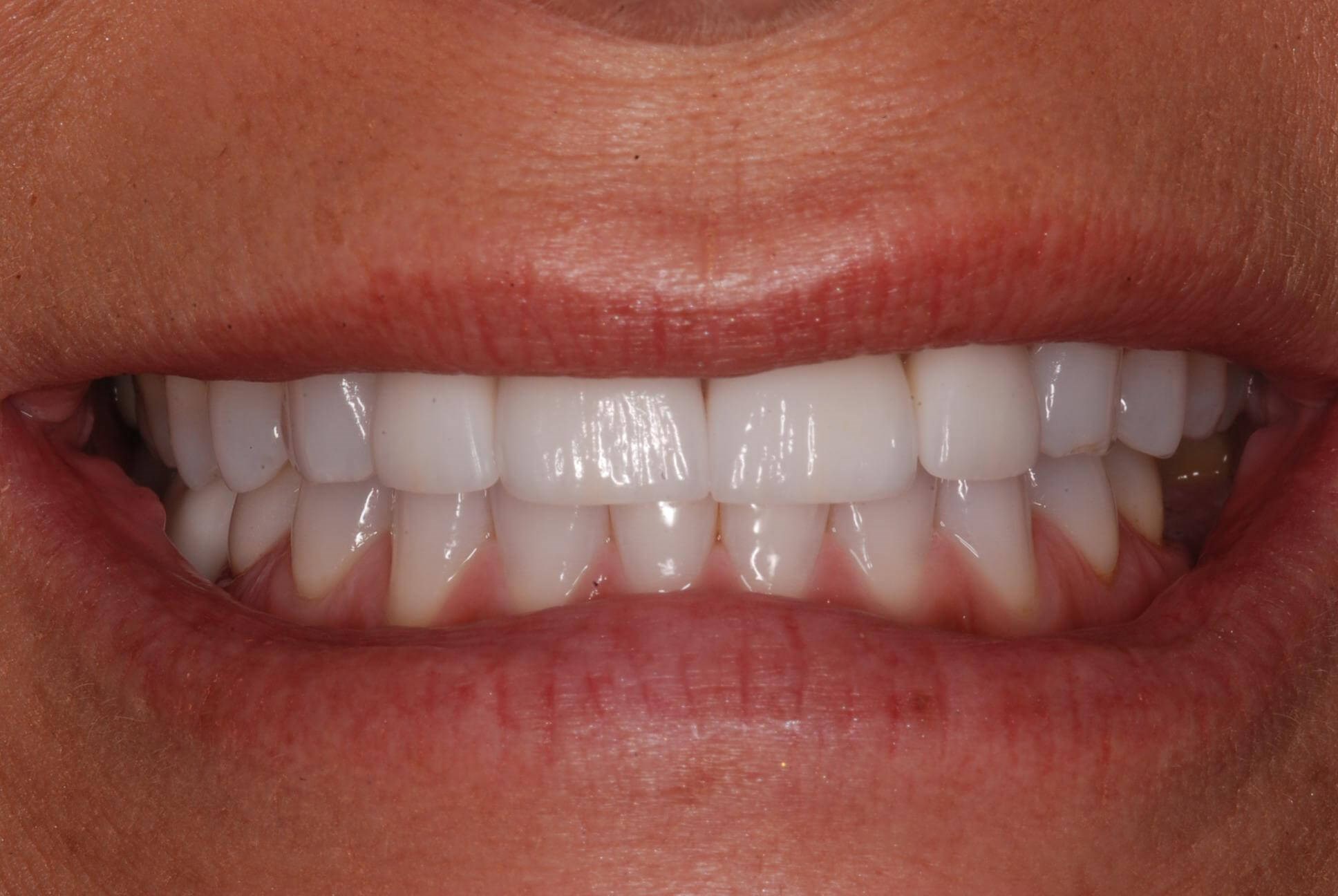 Dental Crowns After