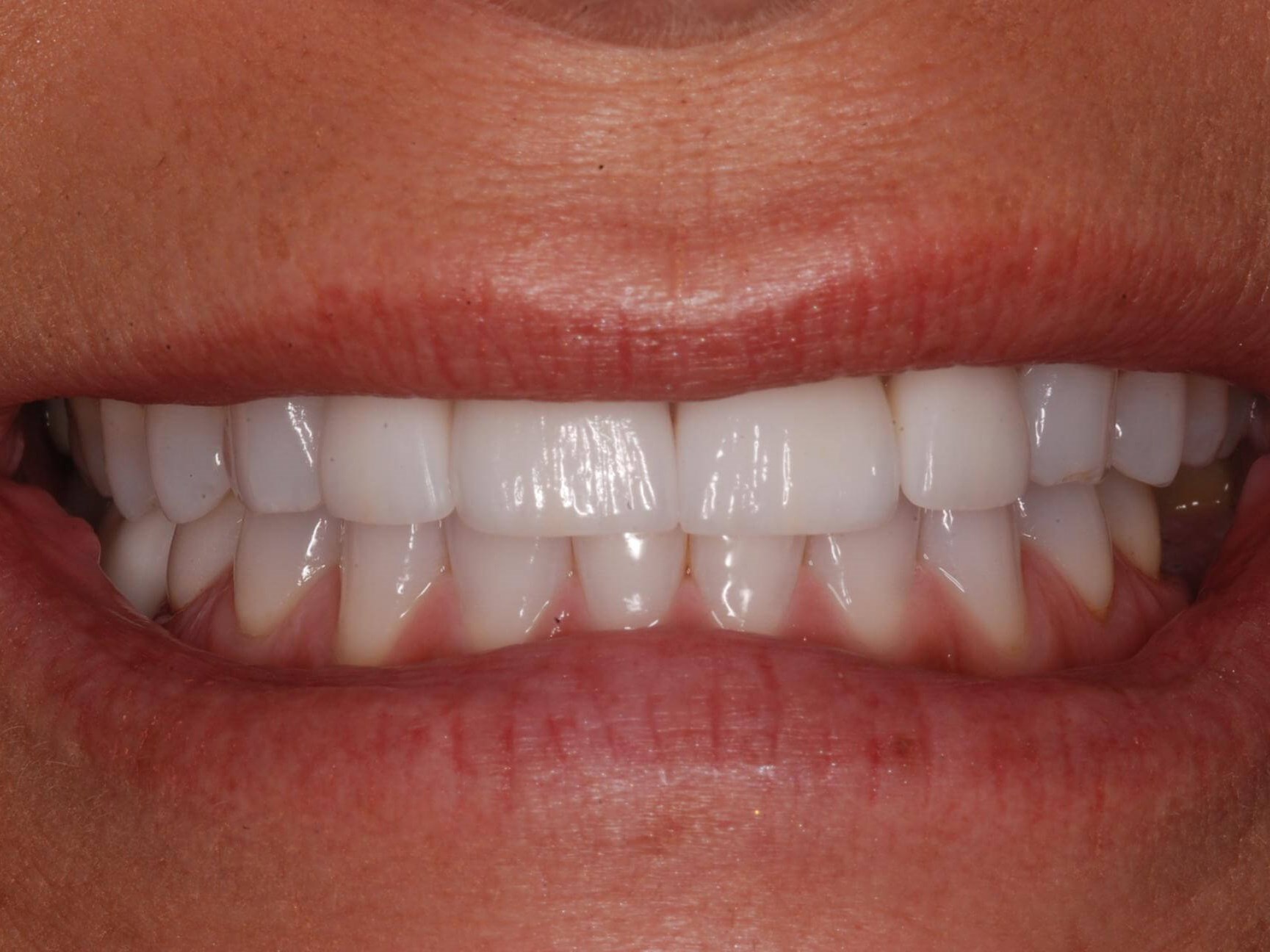 Dental Crowns After