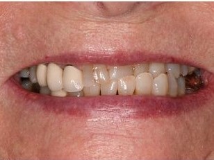 Smile Makeover Before