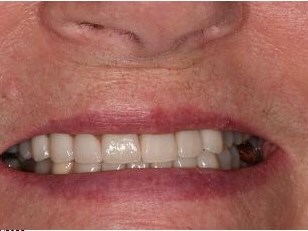Smile Makeover After