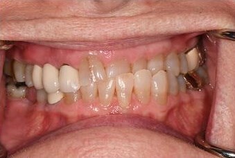 Smile Makeover Before