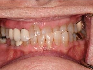Smile Makeover Before
