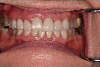 Smile Makeover After
