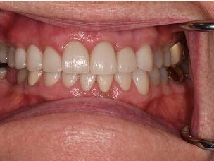 Smile Makeover After