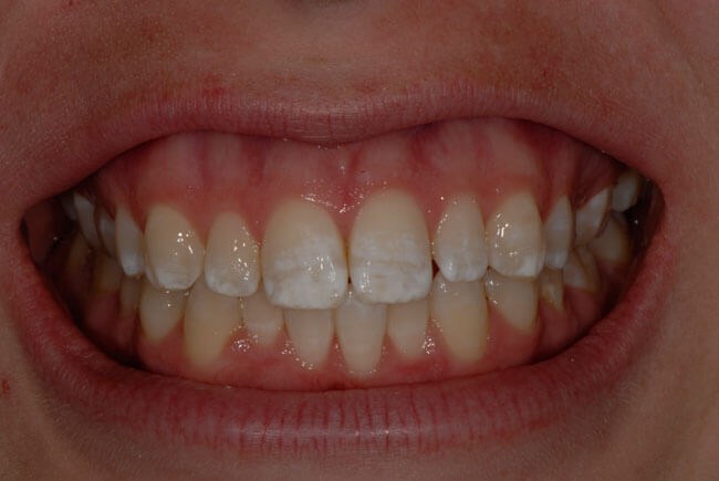 Dental Bonding Before