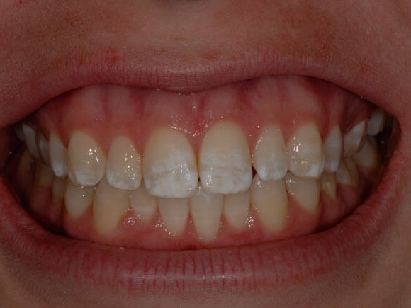 Dental Bonding Before