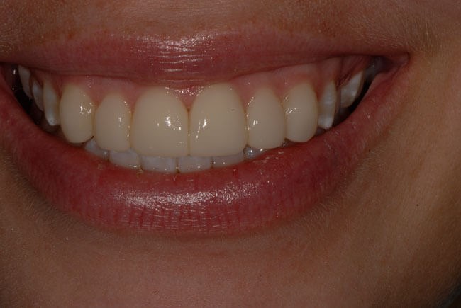 Dental Bonding After