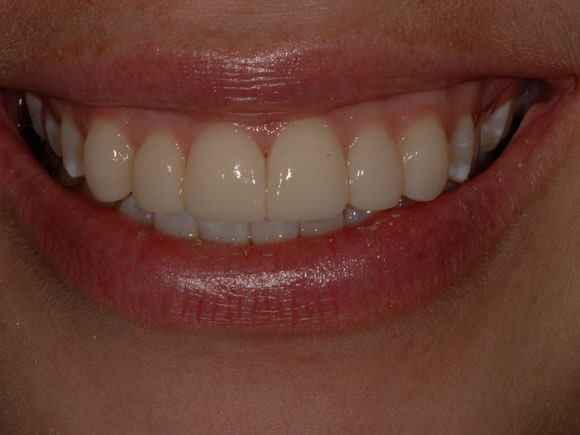 Dental Bonding After