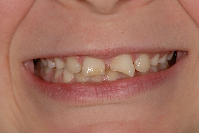 Bonding for chipped teeth Before
