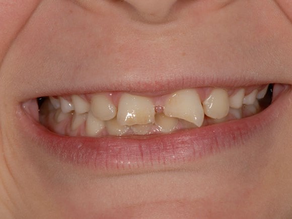 Bonding for chipped teeth Before