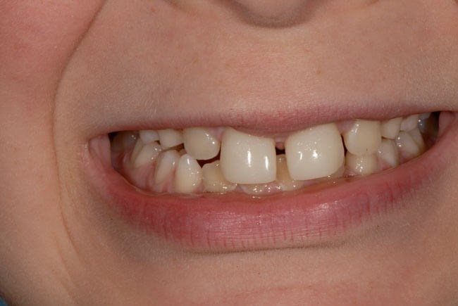 Bonding for chipped teeth After
