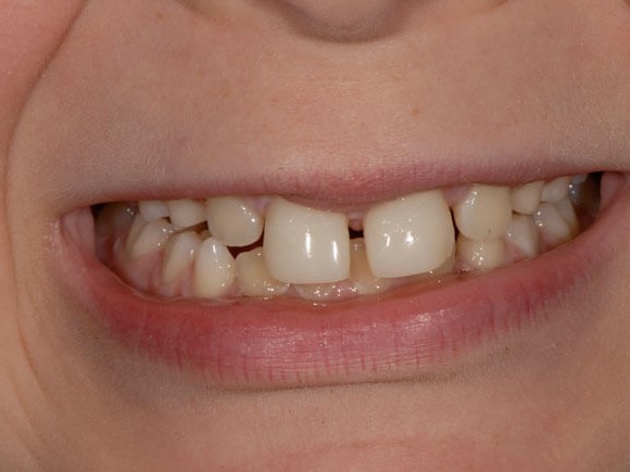Bonding for chipped teeth After