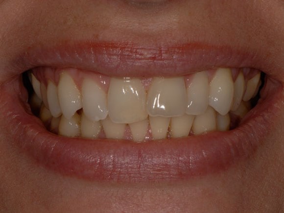 Invisalign Before