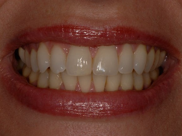 Invisalign After
