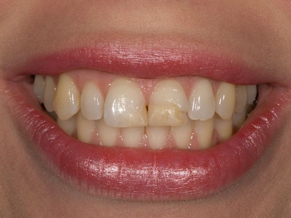 Porcelain Veneers Before