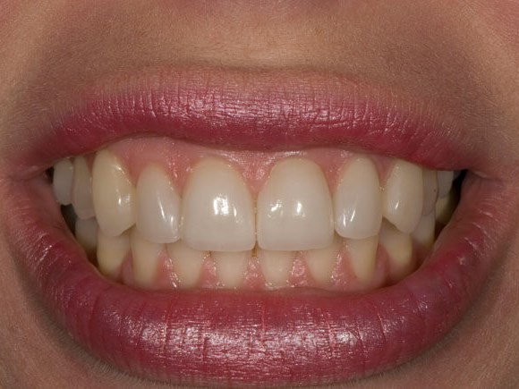 Porcelain Veneers After