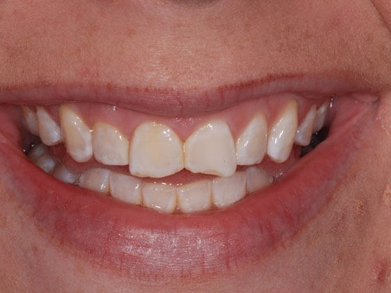 Porcelain Veneers Before
