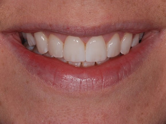 Porcelain Veneers After