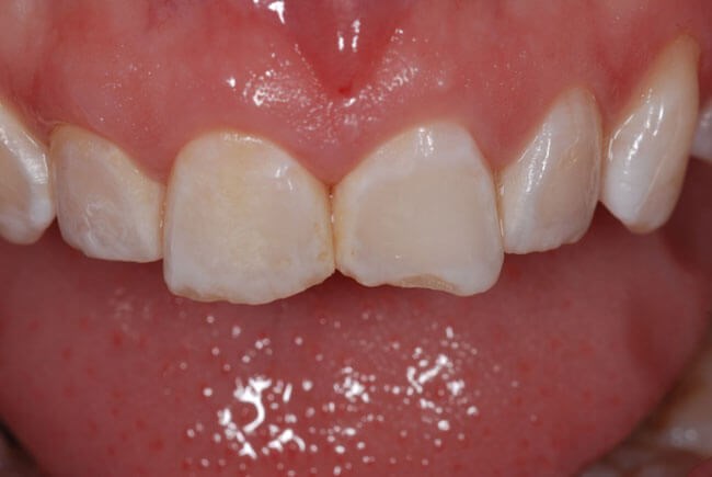 Porcelain Veneers Before (close up)
