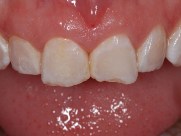 Porcelain Veneers Before (close up)