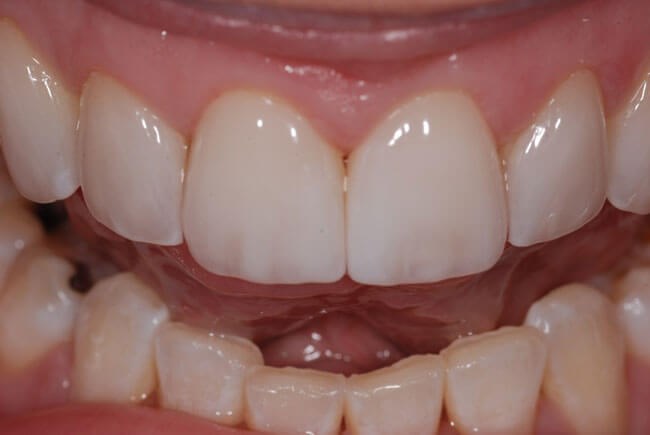 Porcelain Veneers After (close up)